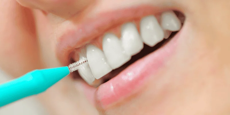 Oral Hygiene Tools for Implants