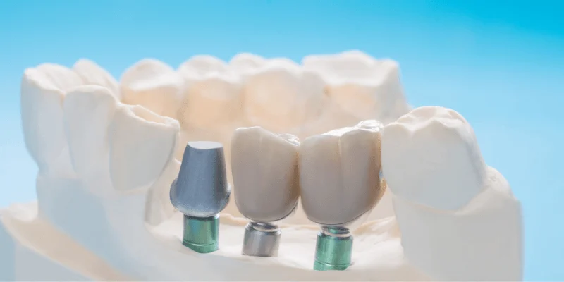 Types of Dental Implants